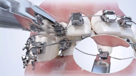 Orthodontic Products は歯列矯正用の受動的セルフ結紮器具を製造しています